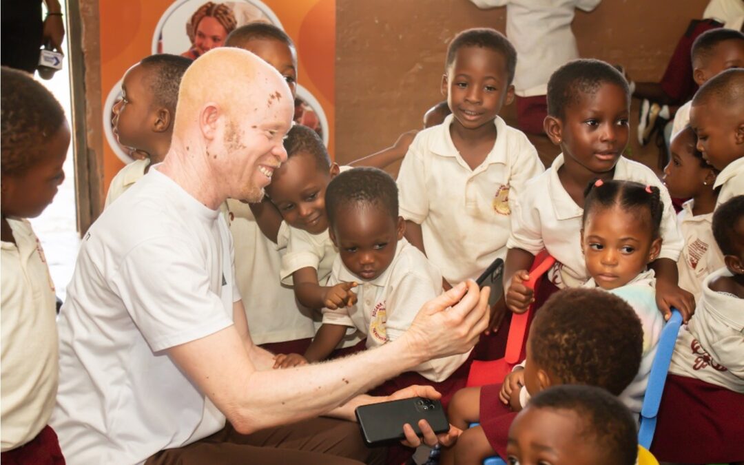 Advocating for People with Albinism in Ghana